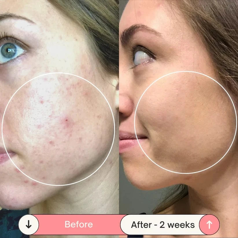DermaVolt - Argon High Frequency Wand