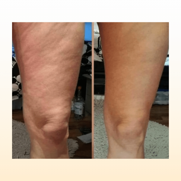 Cellulite Removal OIl