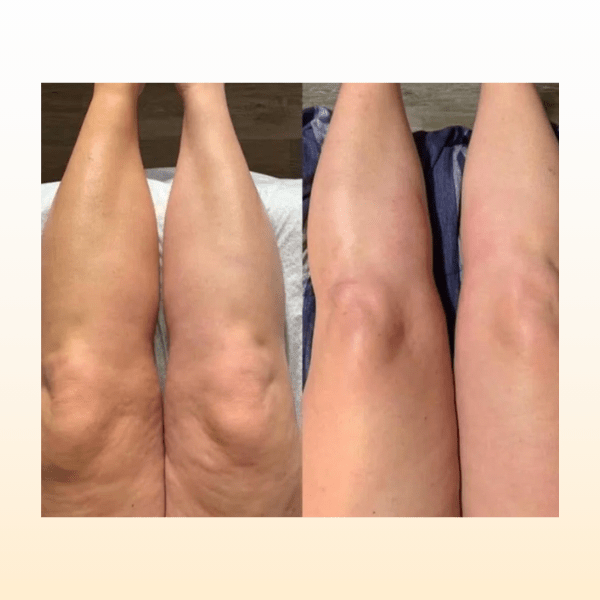 Cellulite Removal OIl