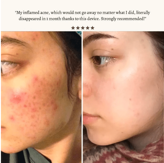 DermaVolt - Argon High Frequency Wand